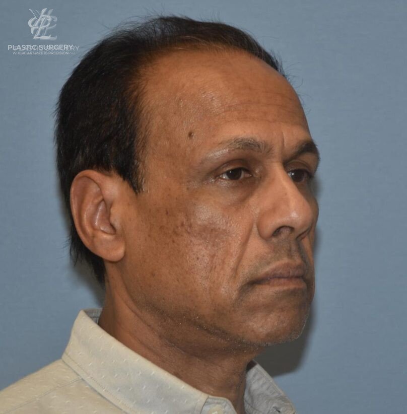 Facial Fat Grafting, patient 1, after, view 2