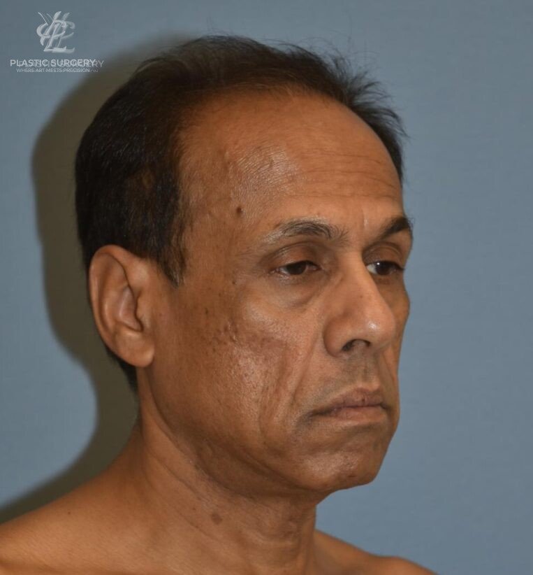 Facial Fat Grafting, patient 1, before, view 2