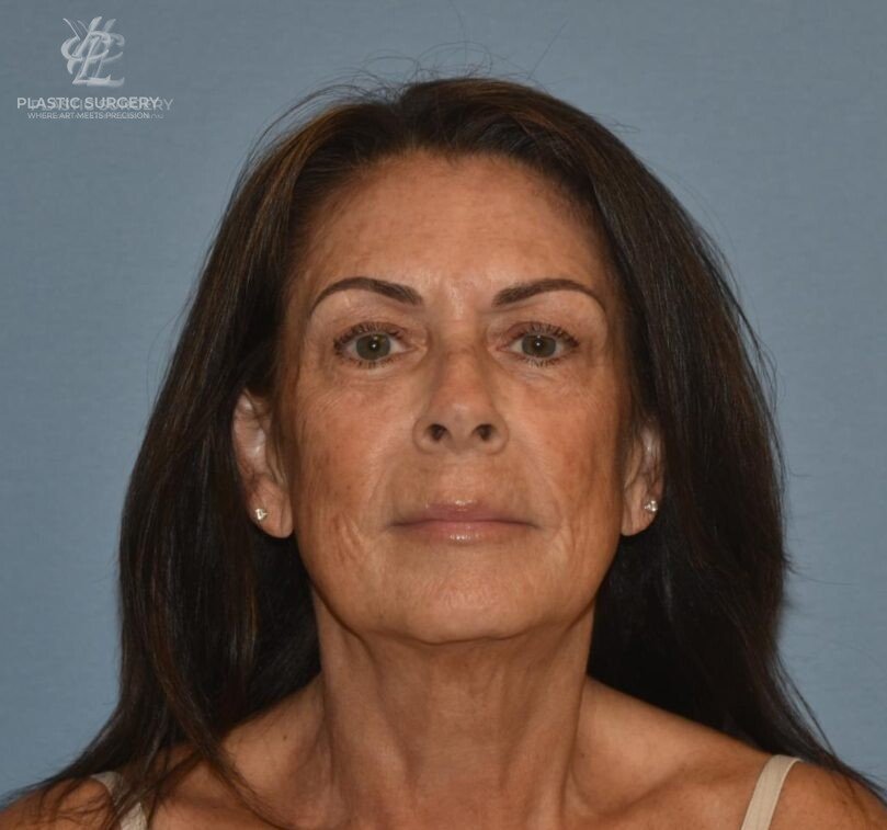 Facial Fat Grafting, patient 2, after, view 1