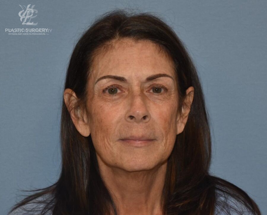 Facial Fat Grafting, patient 2, before, view 1