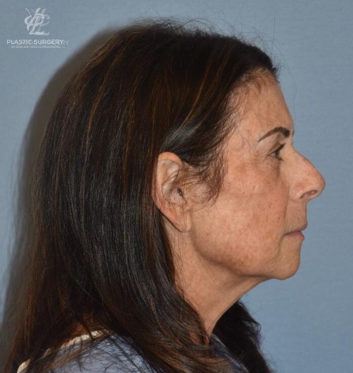 Facial Fat Grafting, patient 2, before, view 3