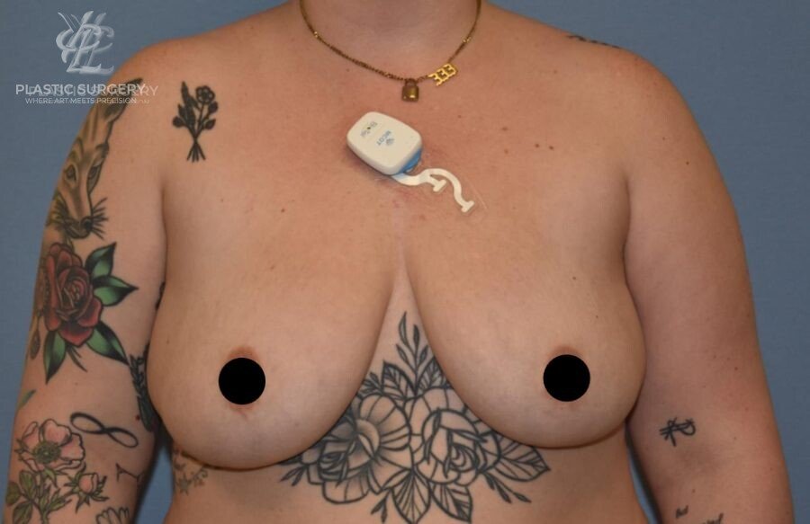 Implant Removal & Explantation, patient 1, after, view 1