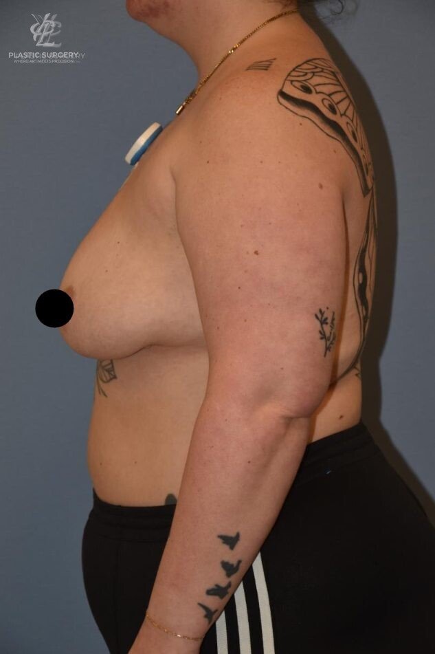 Implant Removal & Explantation, patient 1, after, view 3