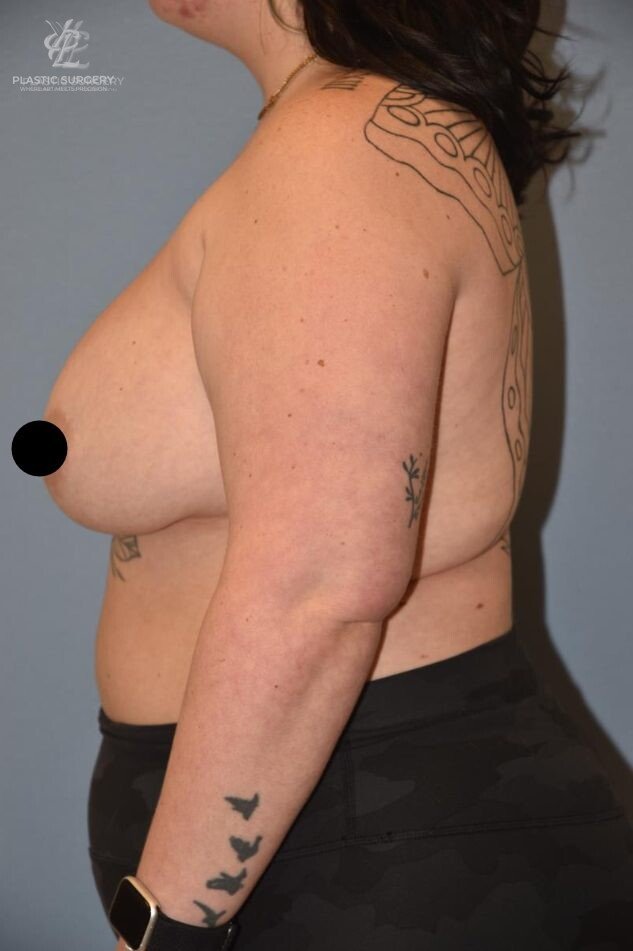 Implant Removal & Explantation, patient 1, before, view 3
