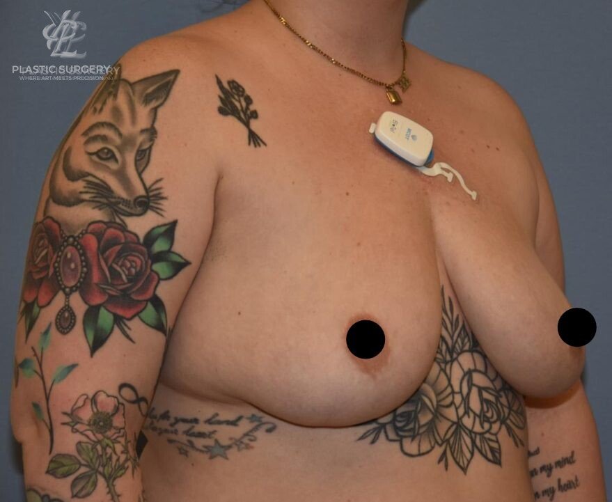 Implant Removal & Explantation, patient 1, after, view 2