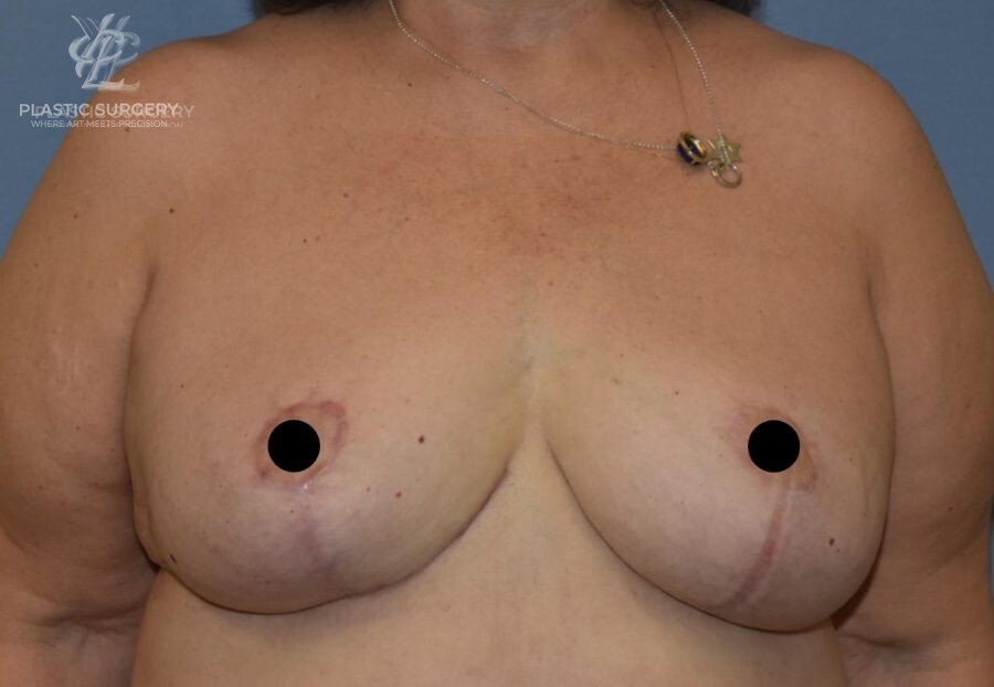 Implant Removal & Explantation, patient 2, after, view 1