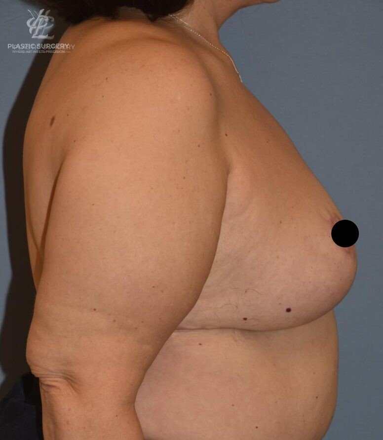 Implant Removal & Explantation, patient 2, after, view 3