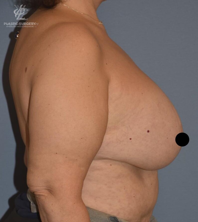 Implant Removal & Explantation, patient 2, before, view 3