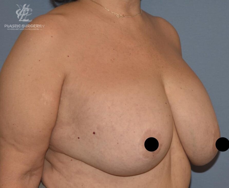Implant Removal & Explantation, patient 2, before, view 2