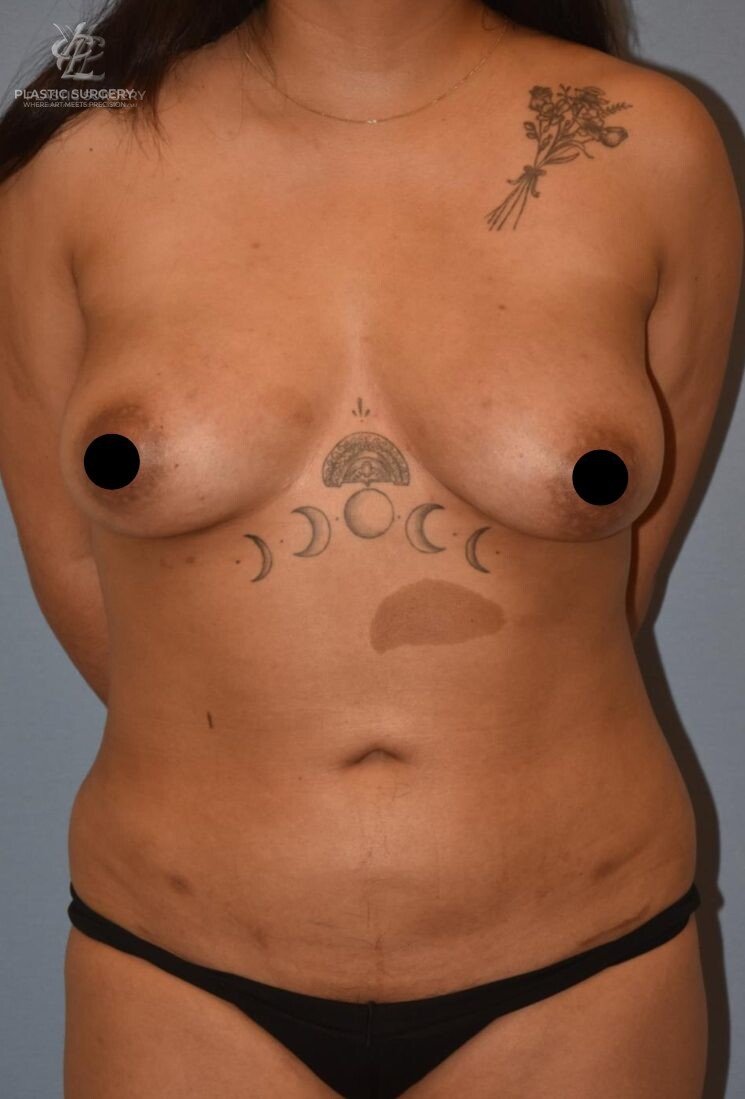Liposuction, patient 1, after, view 1