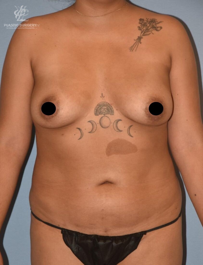 Liposuction, patient 1, before, view 1