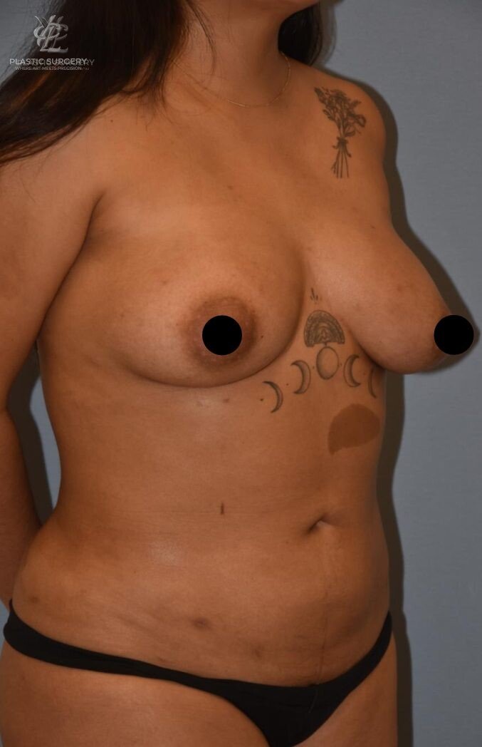 Liposuction, patient 1, after, view 2