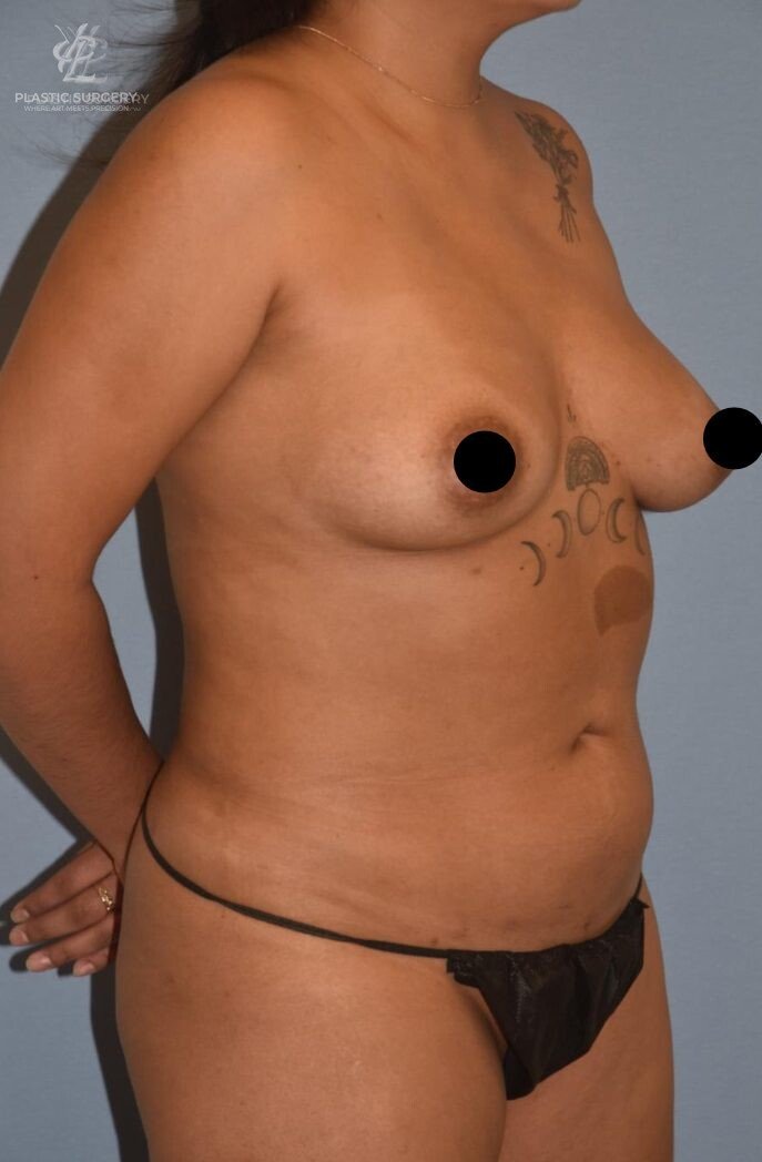 Liposuction, patient 1, before, view 2