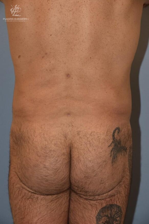 BBL & Buttock Augmentation, patient 1, after, view 1