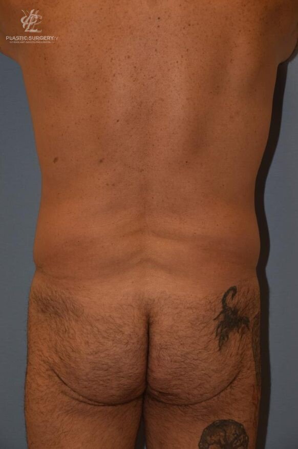 BBL & Buttock Augmentation, patient 1, before, view 1