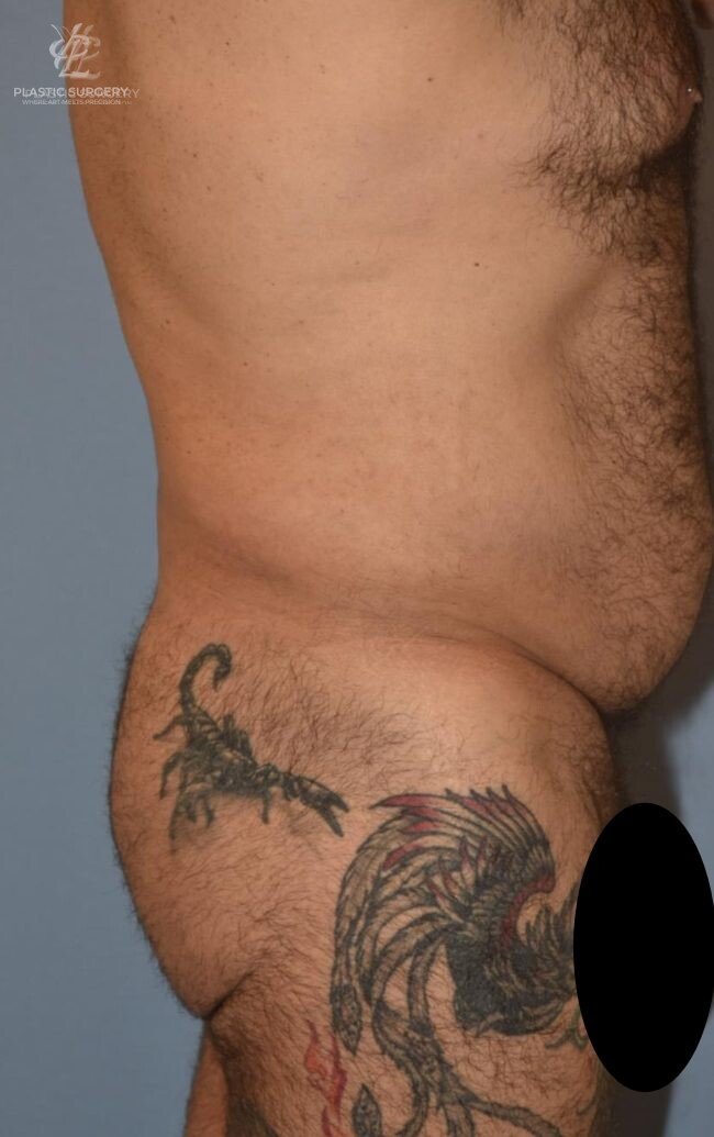 BBL & Buttock Augmentation, patient 1, after, view 3