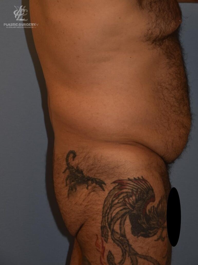BBL & Buttock Augmentation, patient 1, before, view 3
