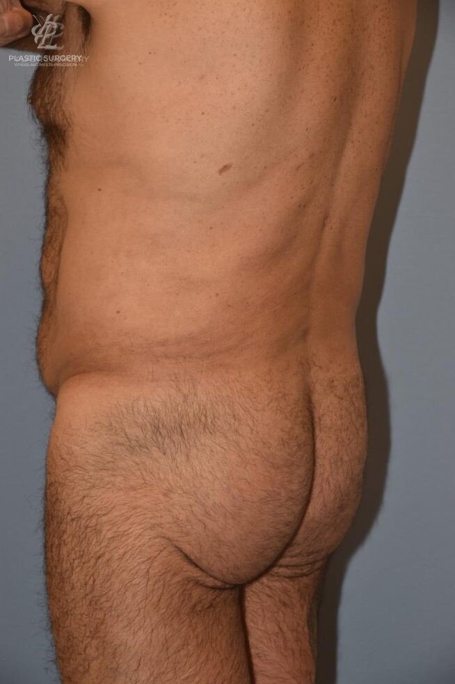 BBL & Buttock Augmentation, patient 1, after, view 2