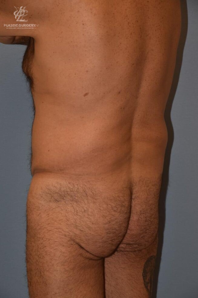 BBL & Buttock Augmentation, patient 1, before, view 2
