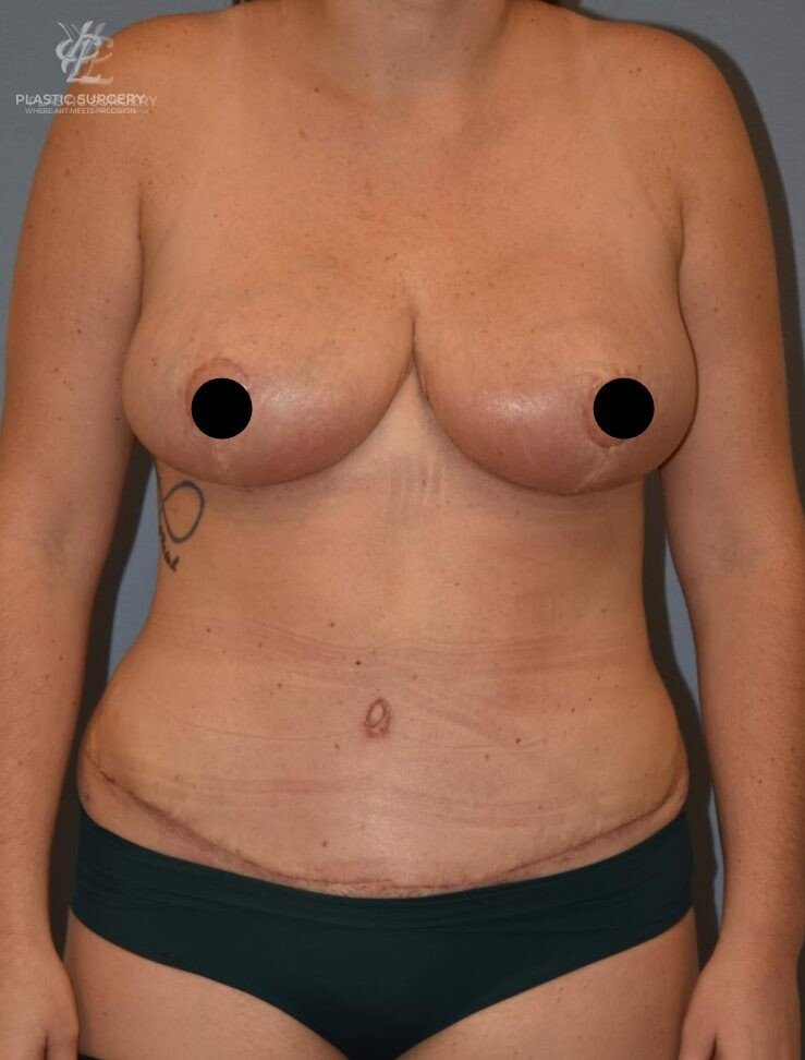 Mommy Makeover, patient 1, after, view 1