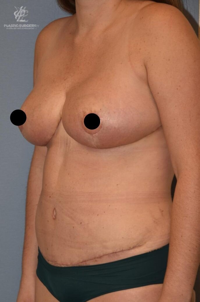 Mommy Makeover, patient 1, after, view 2