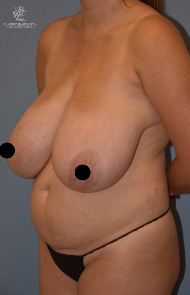 Mommy Makeover, patient 1, before, view 2