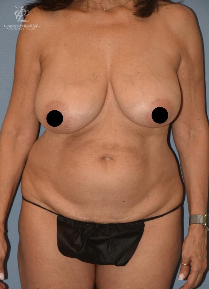 Mommy Makeover, patient 2, before, view 1