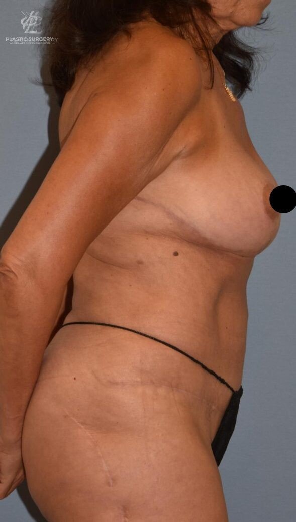 Mommy Makeover, patient 2, after, view 3
