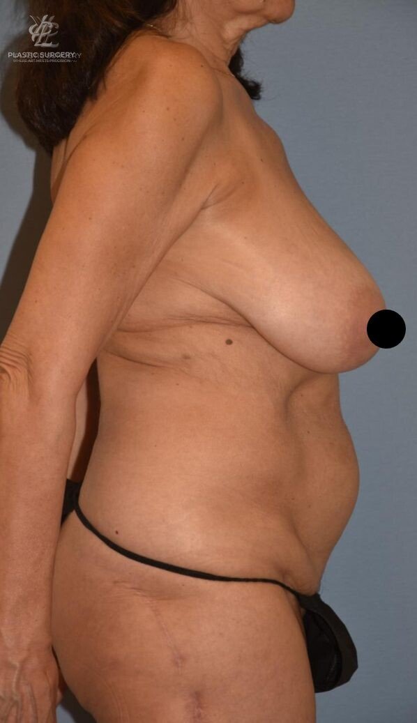 Mommy Makeover, patient 2, before, view 3
