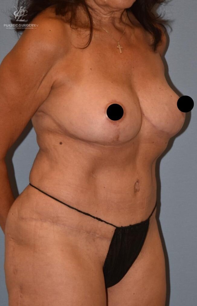 Mommy Makeover, patient 2, after, view 2
