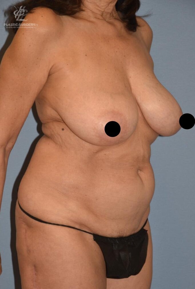 Mommy Makeover, patient 2, before, view 2