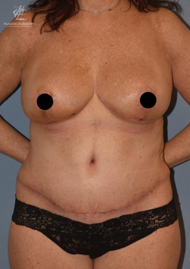 Mommy Makeover, patient 3, after, view 1