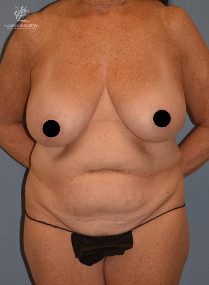 Mommy Makeover, patient 3, before, view 1
