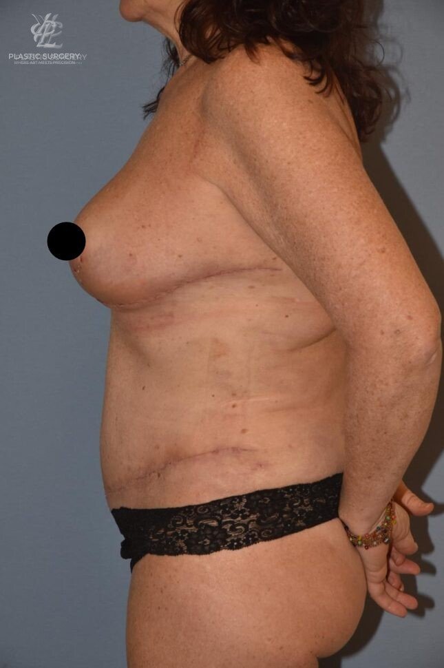 Mommy Makeover, patient 3, after, view 3