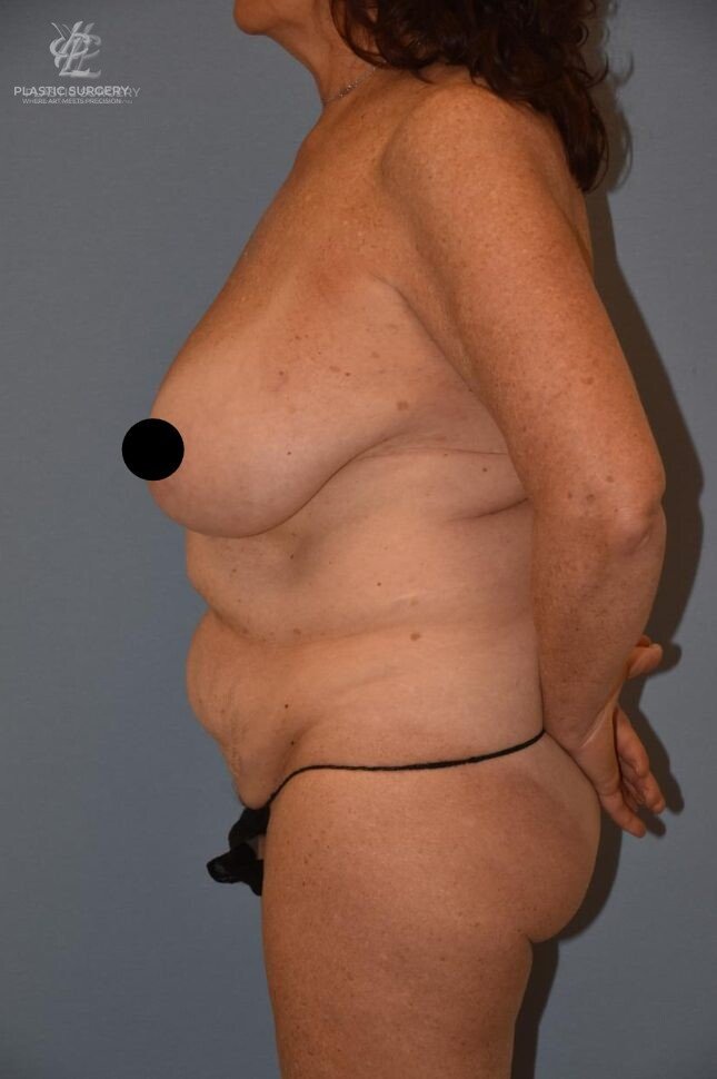 Mommy Makeover, patient 3, before, view 3