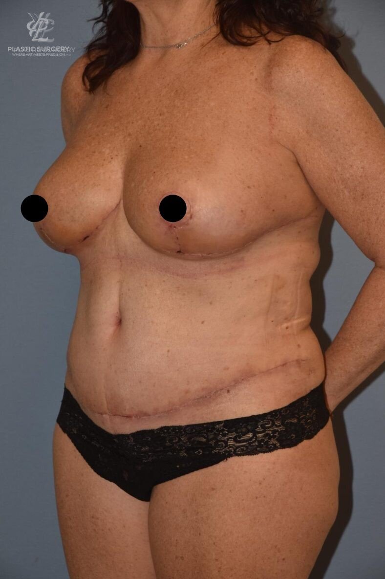 Mommy Makeover, patient 3, after, view 2