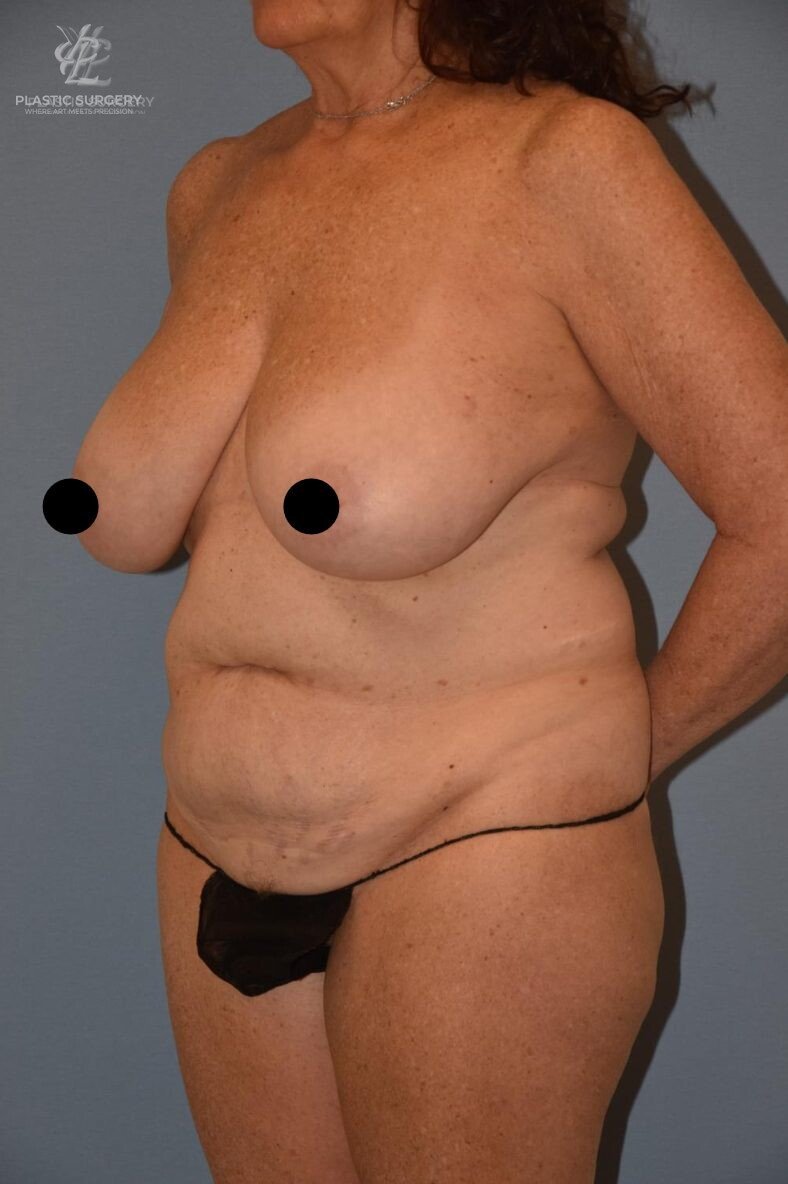 Mommy Makeover, patient 3, before, view 2