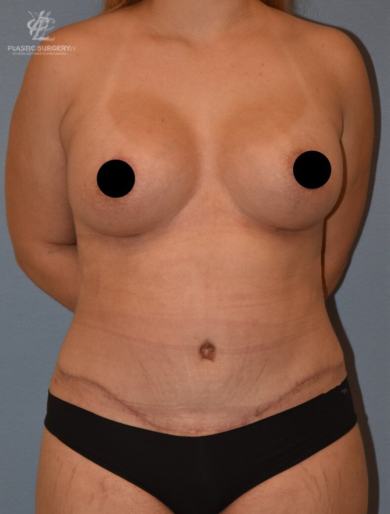 Mommy Makeover, patient 7, after, view 1