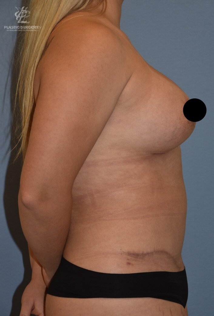 Mommy Makeover, patient 7, after, view 3