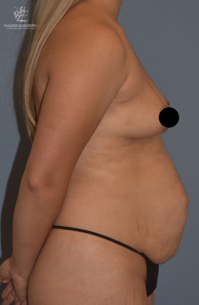 Mommy Makeover, patient 7, before, view 3