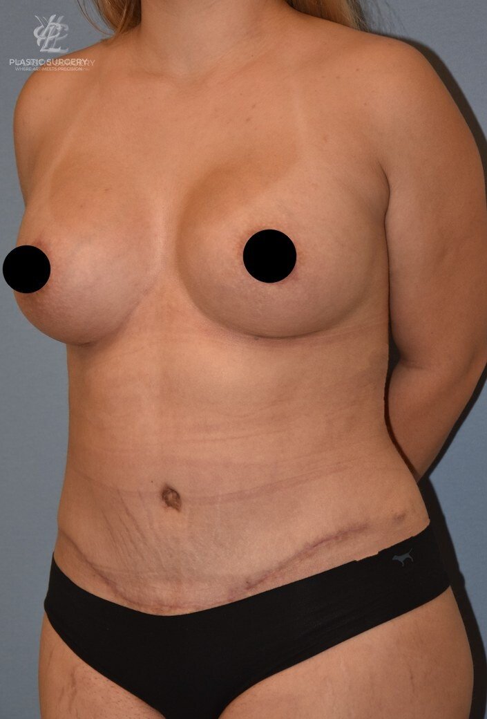 Mommy Makeover, patient 7, after, view 2