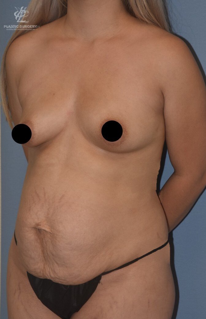 Mommy Makeover, patient 7, before, view 2