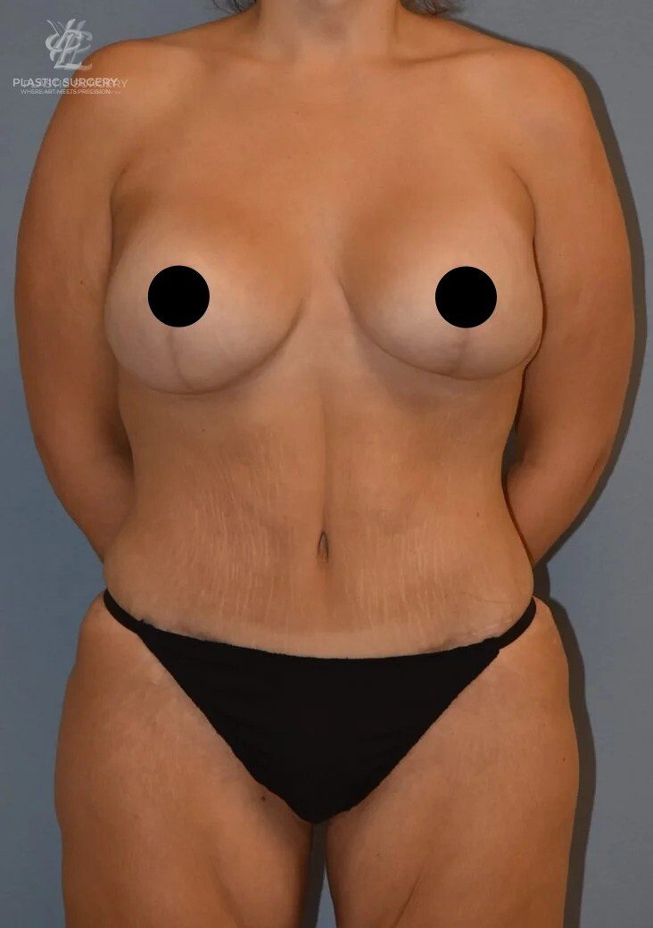 Mommy Makeover, patient 8, after, view 1
