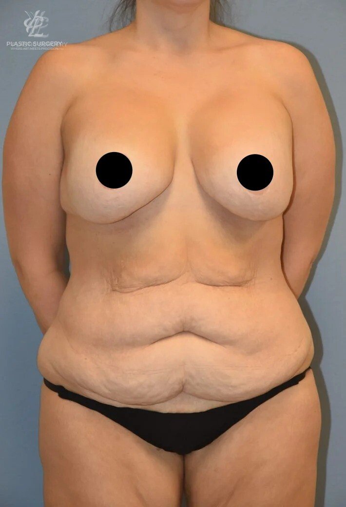 Mommy Makeover, patient 8, before, view 1