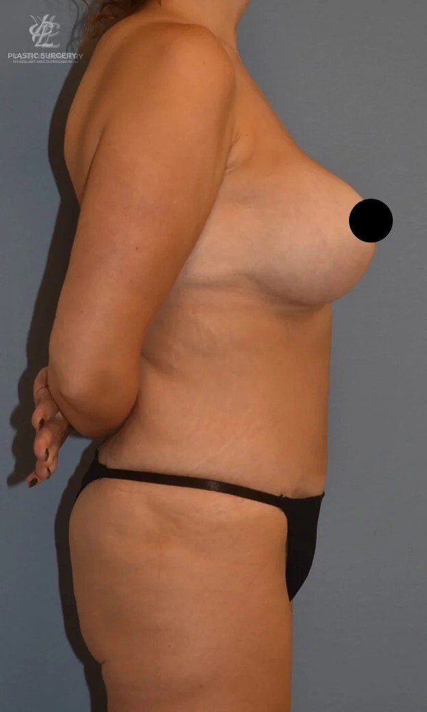 Mommy Makeover, patient 8, after, view 3