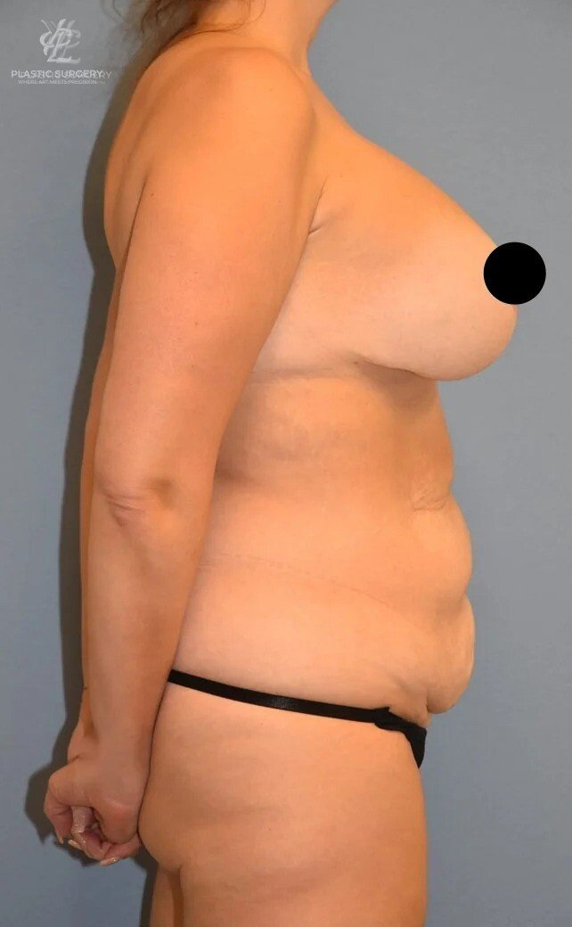 Mommy Makeover, patient 8, before, view 3