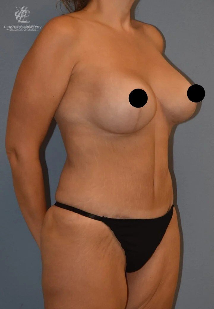 Mommy Makeover, patient 8, after, view 2
