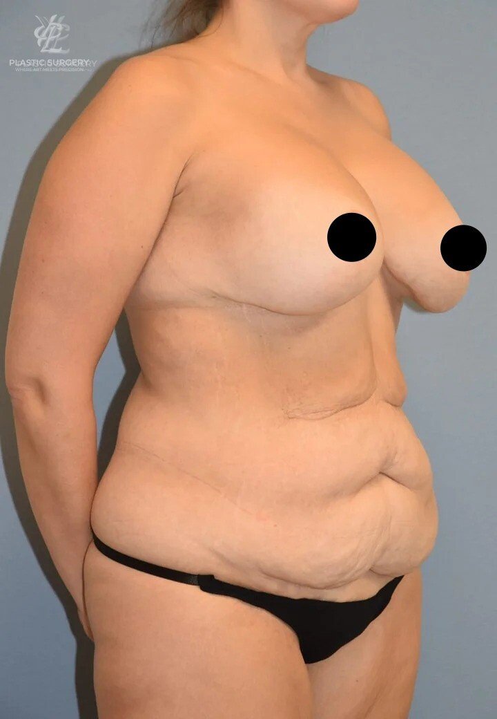 Mommy Makeover, patient 8, before, view 2
