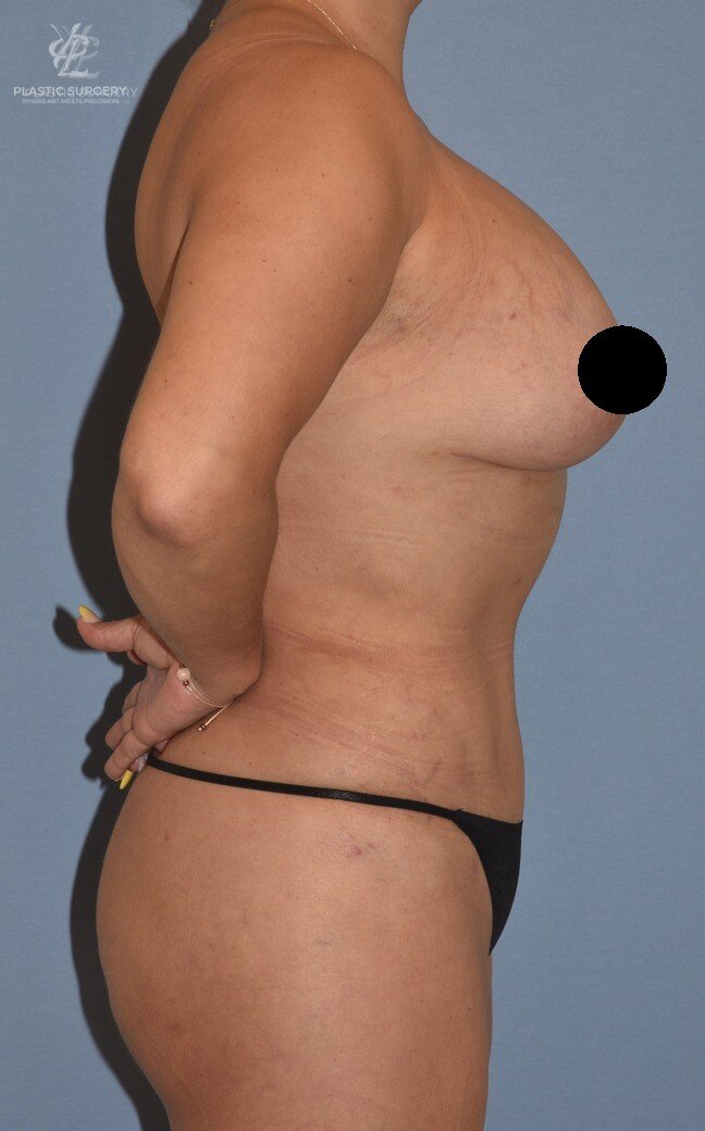 Mommy Makeover, patient 4, after, view 3