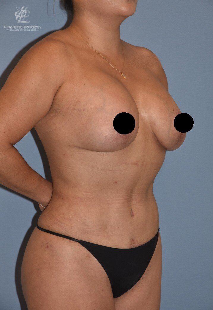 Mommy Makeover, patient 4, after, view 2